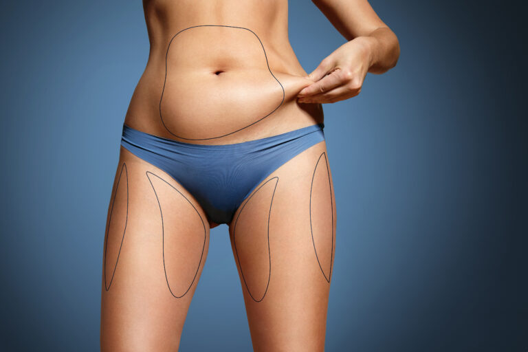 Laser Lipo Dallas