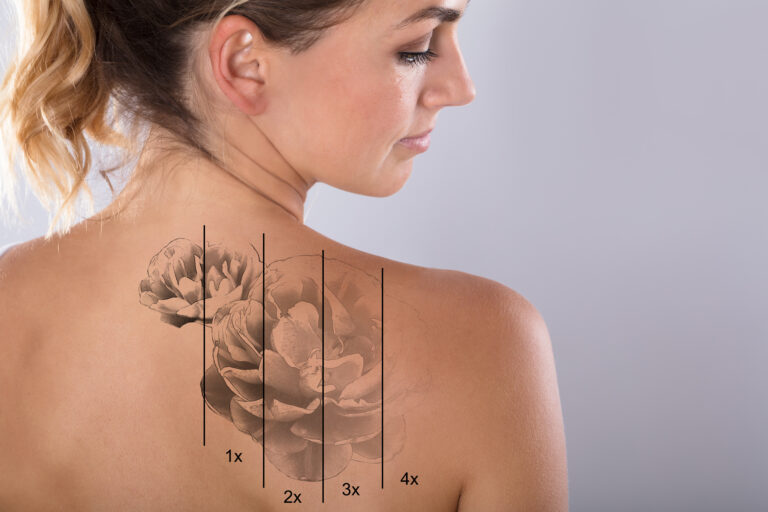 tattoo removal dallas