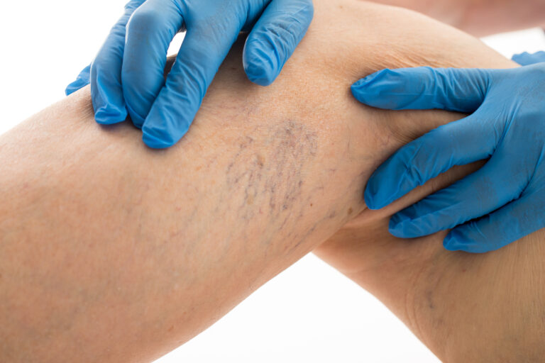 Sclerotherapy Dallas