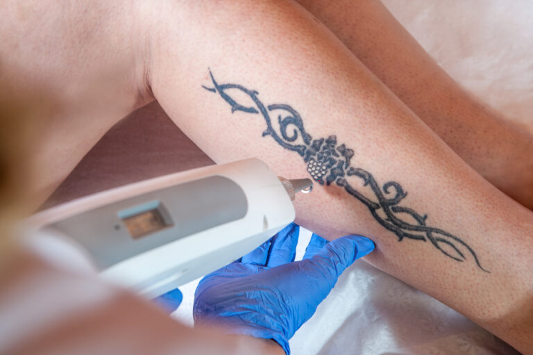 Laser Tattoo Removal Dallas