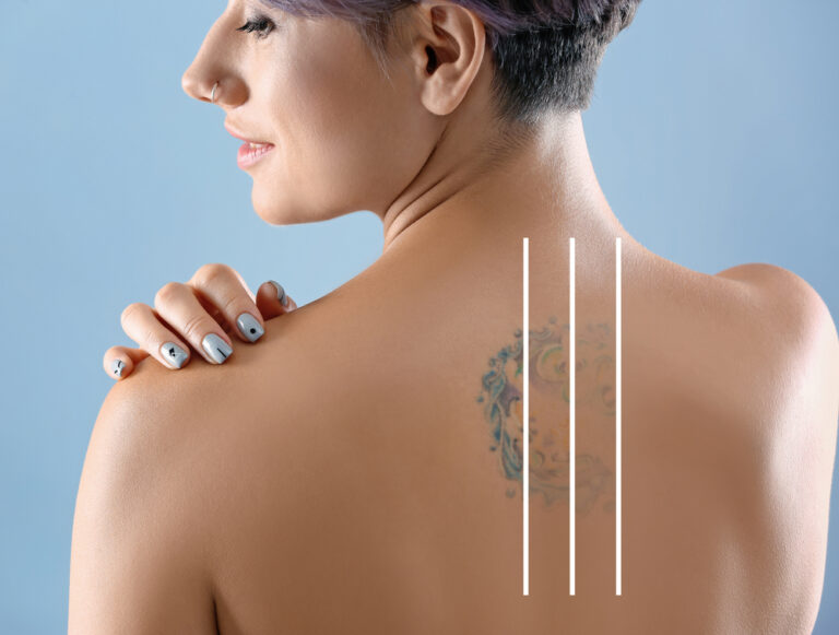 Tattoo Removal Dallas