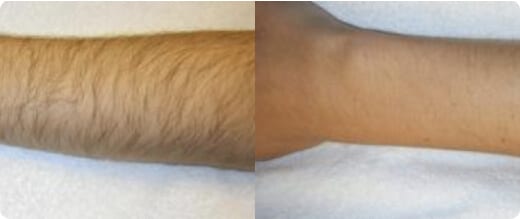 Pain-Free Laser Hair Removal Dallas Plano