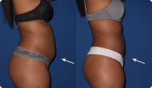 Laser Lipo Dallas Plano