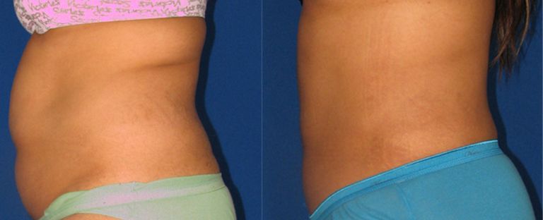 Liposuction Dallas