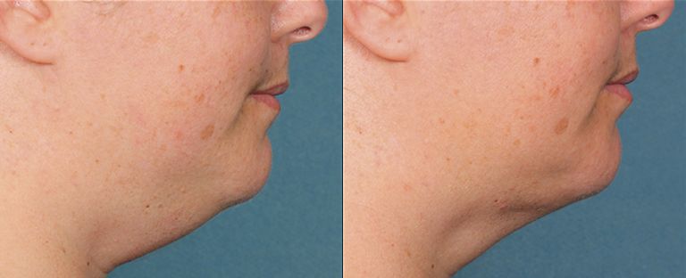 Kybella Dallas