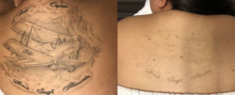 Laser Tattoo Removal Dallas