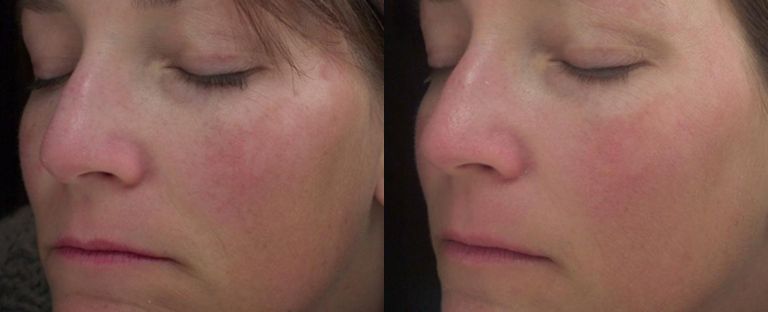 Chemical Peel Dallas