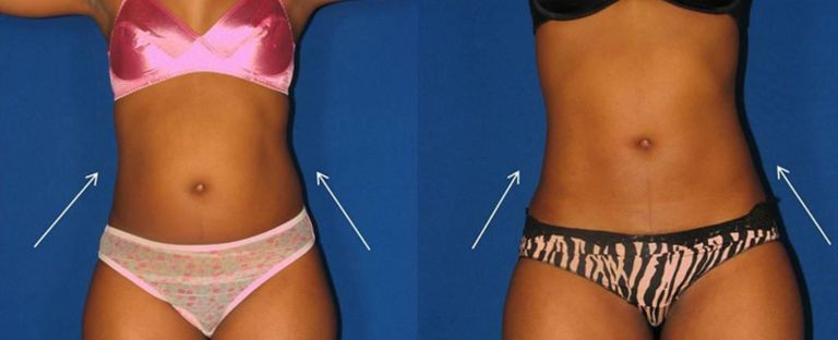 Liposuction Dallas