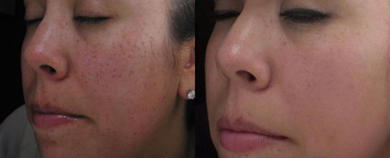 Laser Skin Resurfacing Dallas