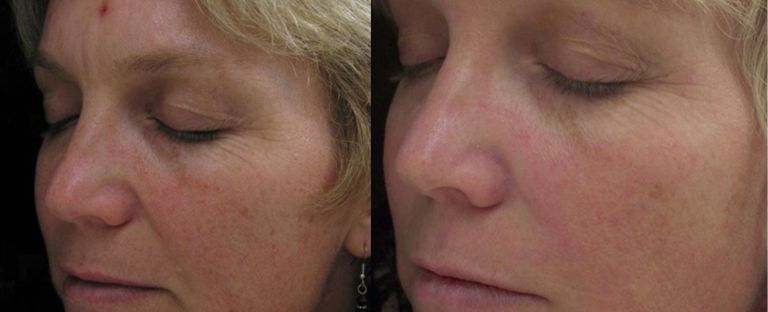 Laser Skin Resurfacing Dallas