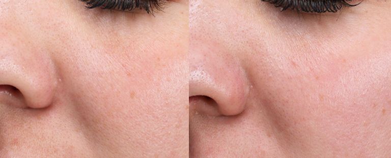 Laser Skin Resurfacing Dallas