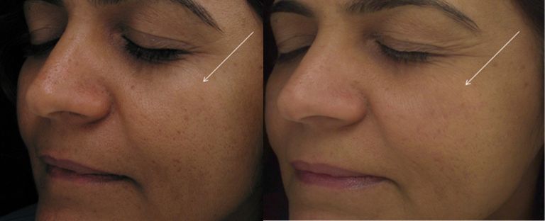 Laser Skin Resurfacing Dallas