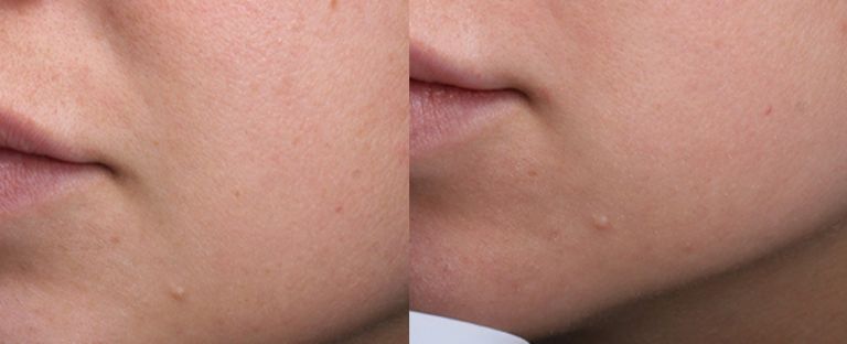 Microneedling Dallas