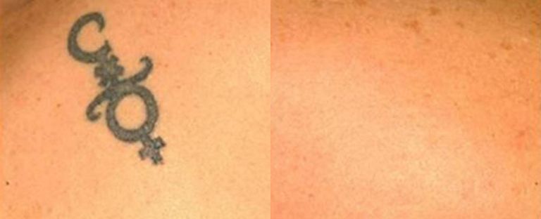 Laser Tattoo Removal Dallas