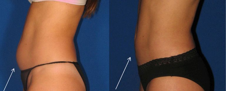 Liposuction Dallas