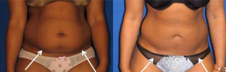 Liposuction Dallas