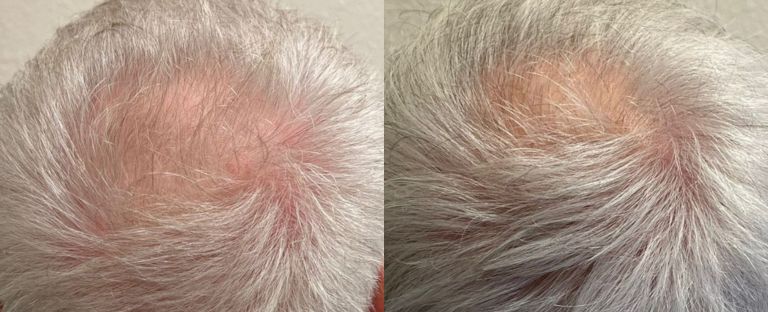 PRP Hair Restoration Dallas