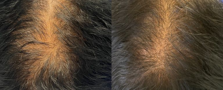 PRP Hair Restoration Dallas