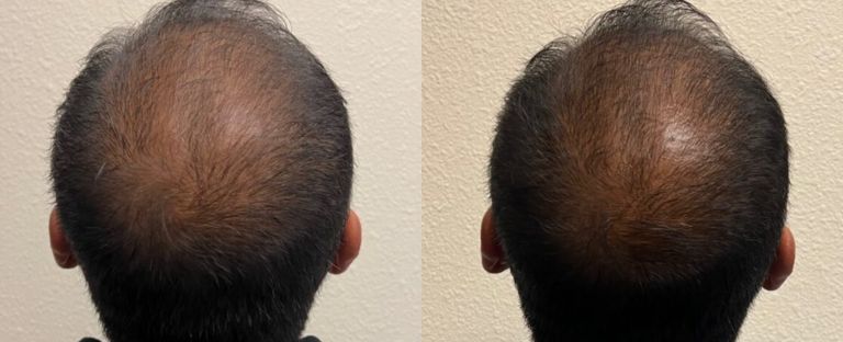 PRP Hair Restoration Dallas