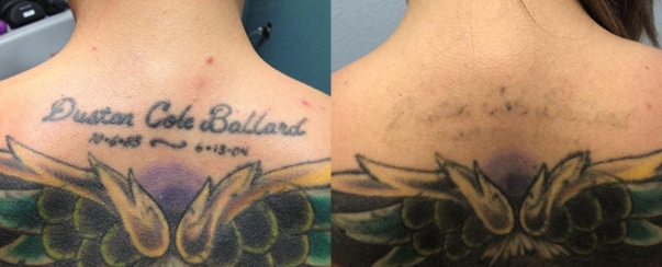 Laser Tattoo Removal BA Dallas