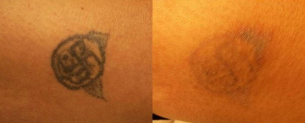 Laser Tattoo Removal BA Dallas