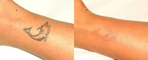 Laser Tattoo Removal BA Dallas