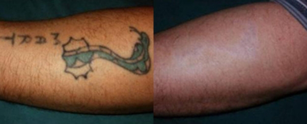 Laser Tattoo Removal BA Dallas