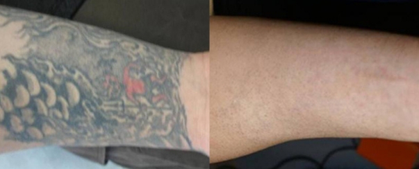 Laser Tattoo Removal BA Dallas