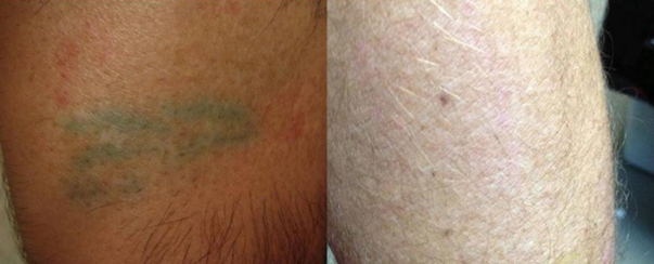 Laser Tattoo Removal BA Dallas