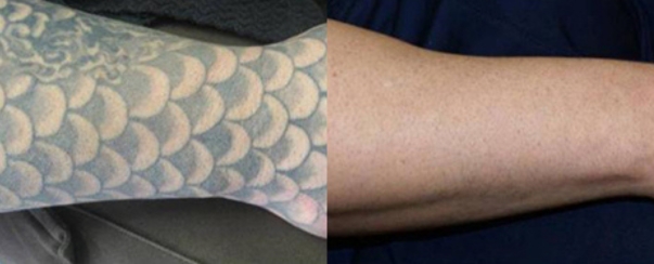 Laser Tattoo Removal BA Dallas