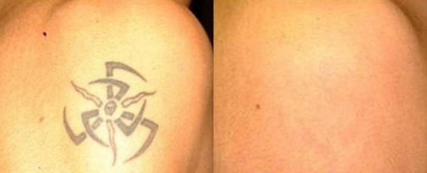 Laser Tattoo Removal BA Dallas