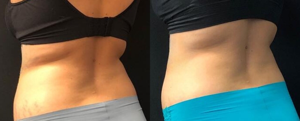 CoolSculpting BA Dallas