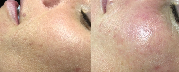 PhotoFacial BA Dallas