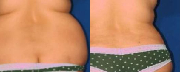 CoolSculpting BA Dallas