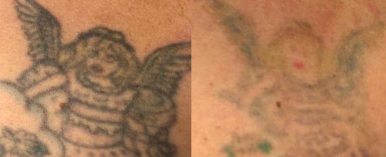 Laser Tattoo Removal Dallas