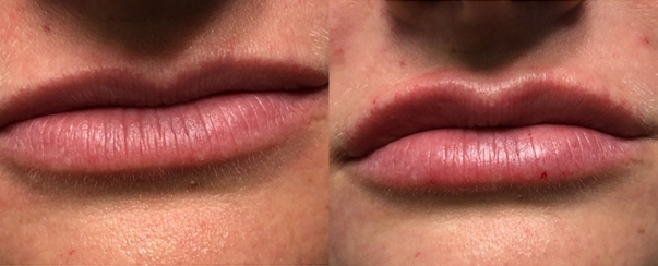 Lip Filler BA Dallas