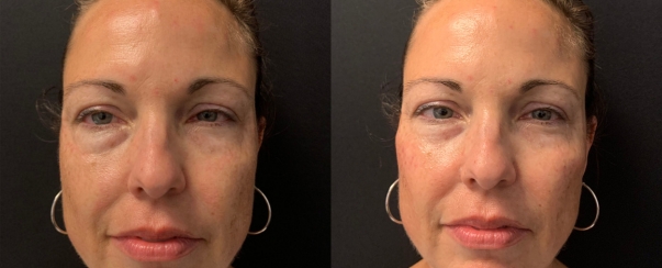 PhotoFacial BA Dallas