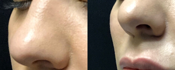 Rhinoplasty BA Dallas