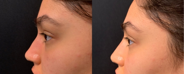 PhotoFacial BA Dallas