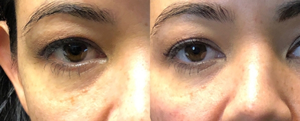 PhotoFacial BA Dallas