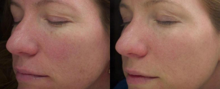 pixel skin resurfacing BA dallas