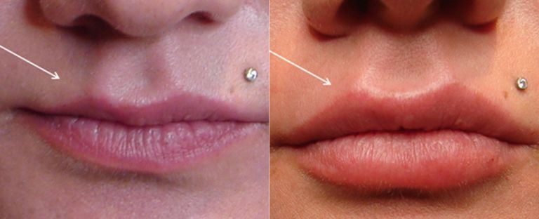 Lip Fillers Dallas