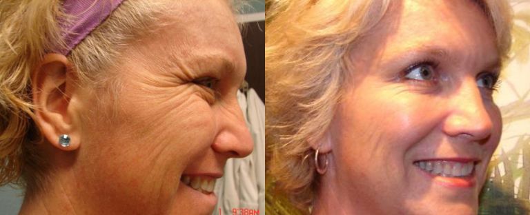 Laser Skin Resurfacing Dallas