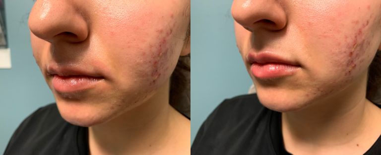 Microneedling Dallas