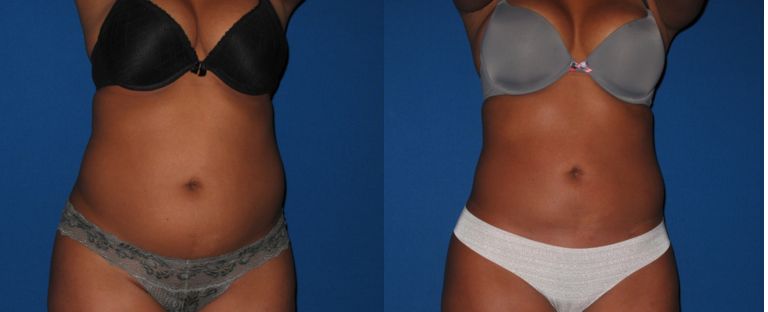 Liposuction BA Dallas