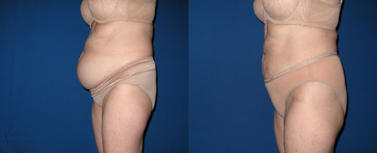 Liposuction BA Dallas