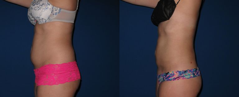 Liposuction BA Dallas