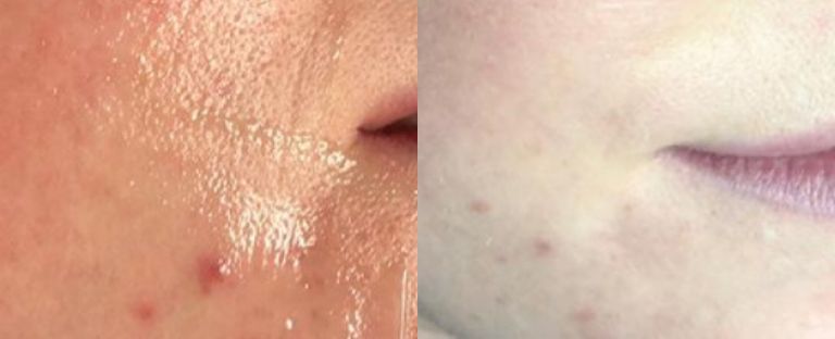 pixel skin resurfacing BA dallas