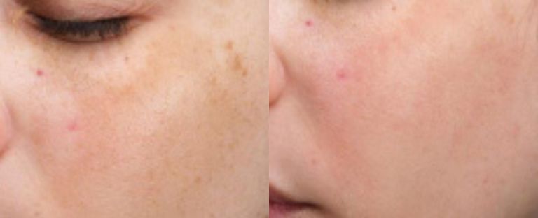 pixel skin resurfacing BA dallas