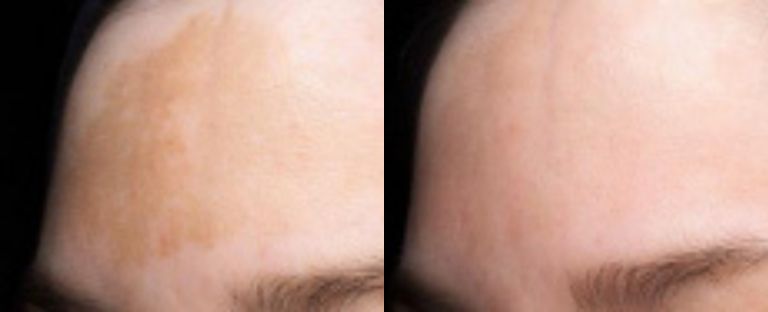 pixel skin resurfacing BA dallas